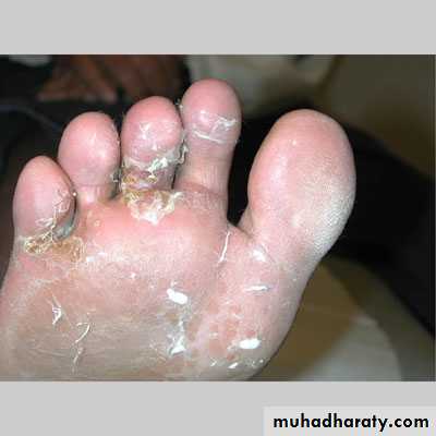 FUNGAL INFECTION 2