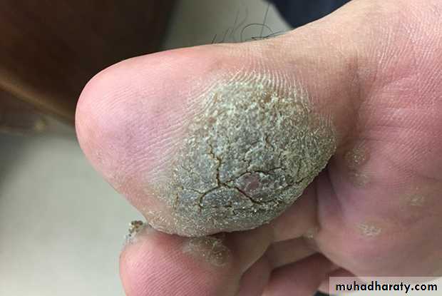 Viral infection 1