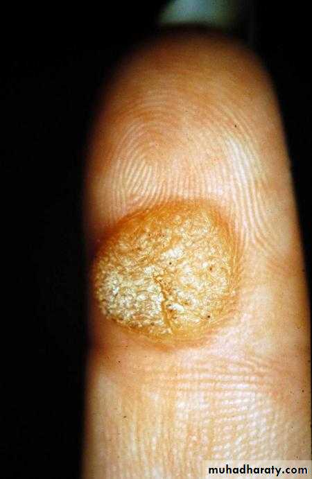 Viral infection 1