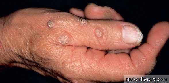 Viral infection 1