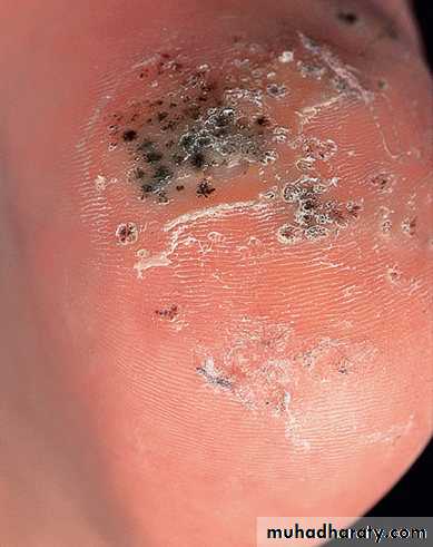Viral infection 1
