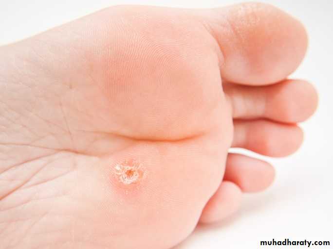 Viral infection 1