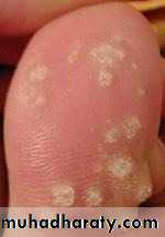 Viral infection 1