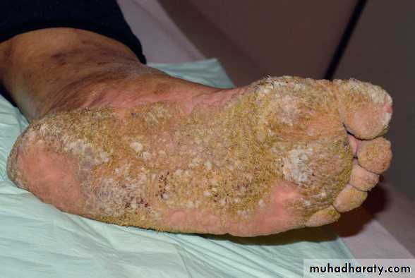 Viral infection 1