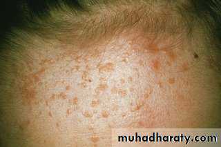 Viral infection 1