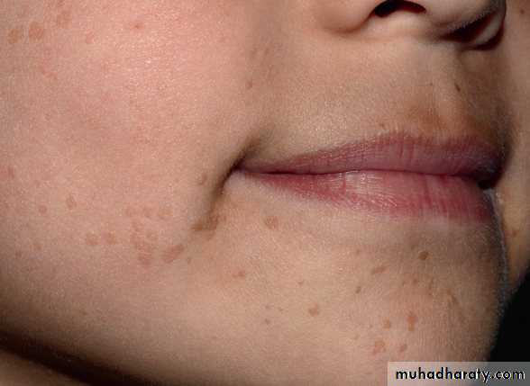 Viral infection 1