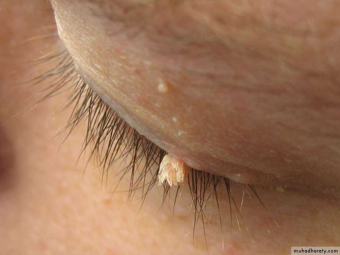 Viral infection 1