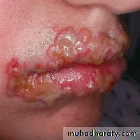 Viral infection 1