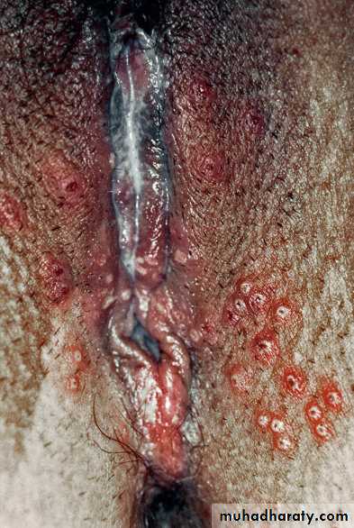 Viral infection 1