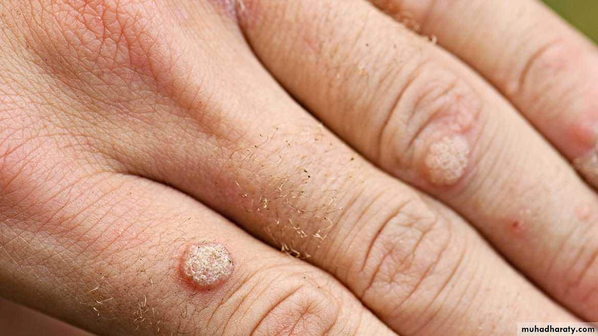Viral infection 1
