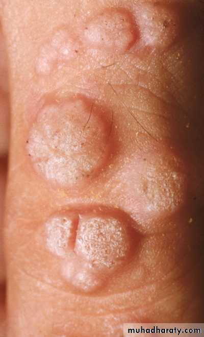Viral infection 1