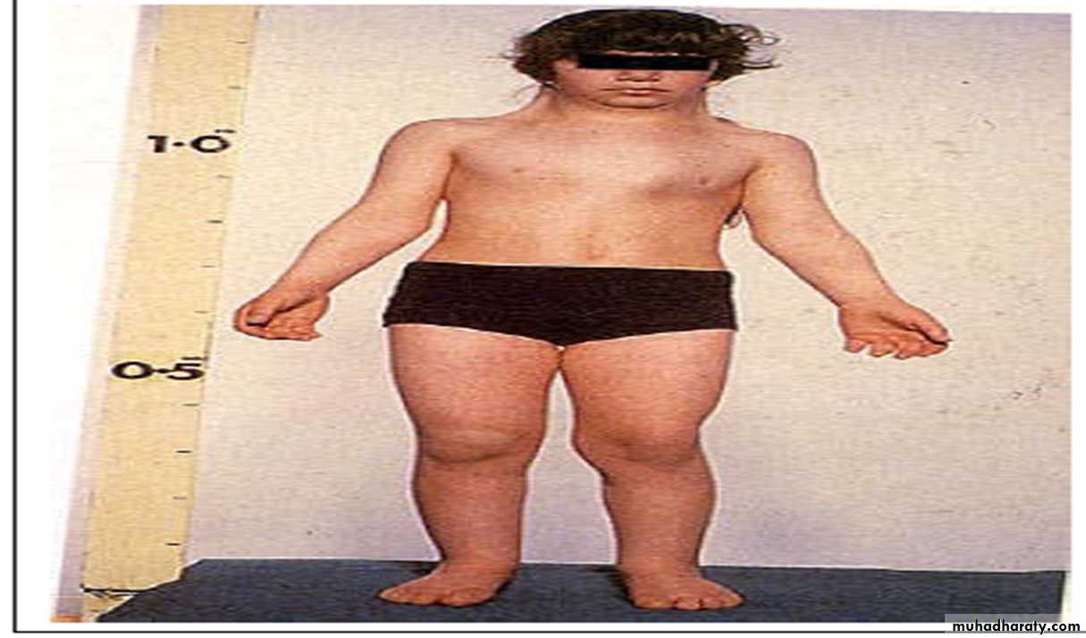 Primary amenorrhea