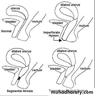 Primary amenorrhea