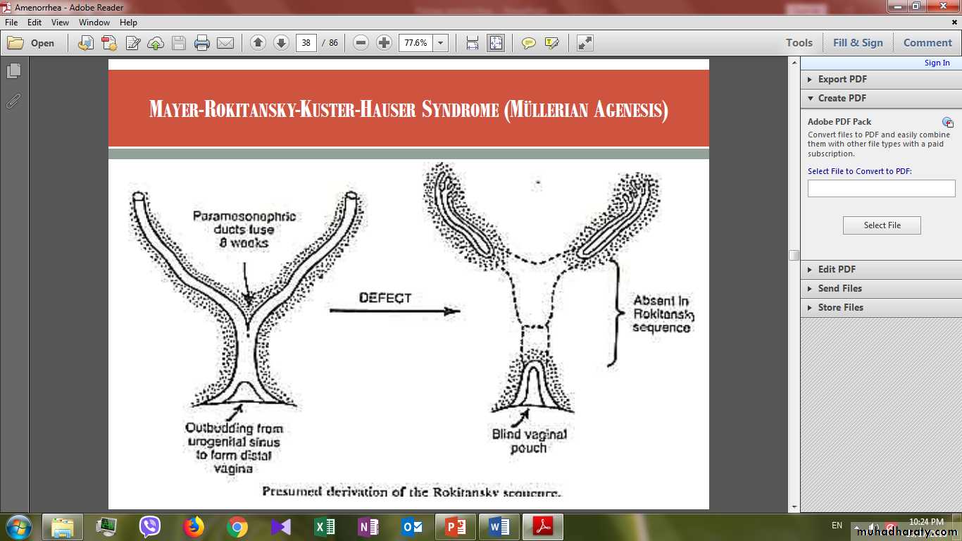 Primary amenorrhea