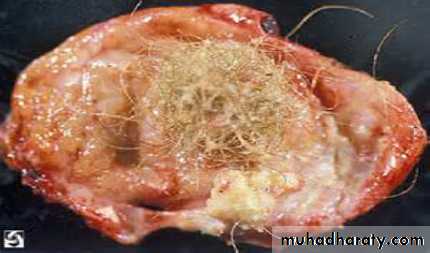 Secondary amenorrhea