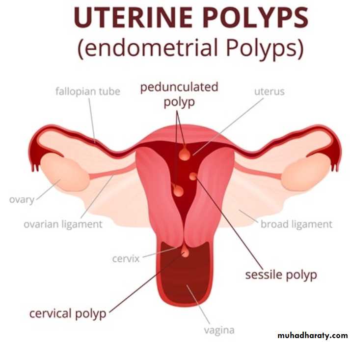 ABNORMAL UTERINE BLEEDING