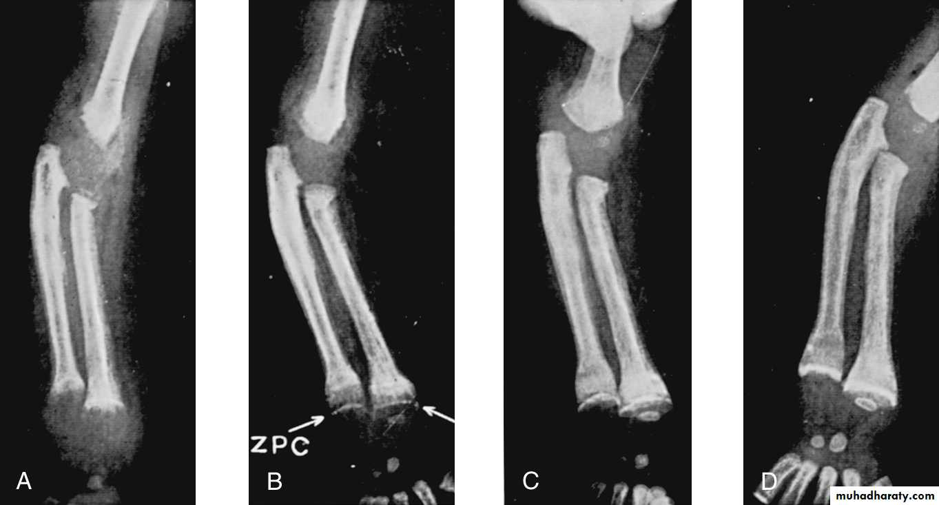 Rickets