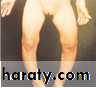 Rickets