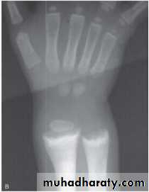 Rickets