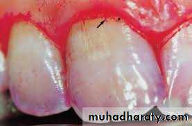 Host defense in the dentogingival area