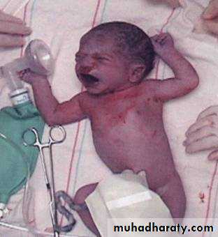 Resuscitation of The Newborn Baby