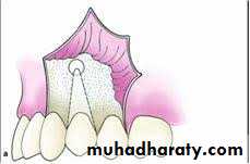 Surgical extraction