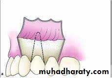 Surgical extraction