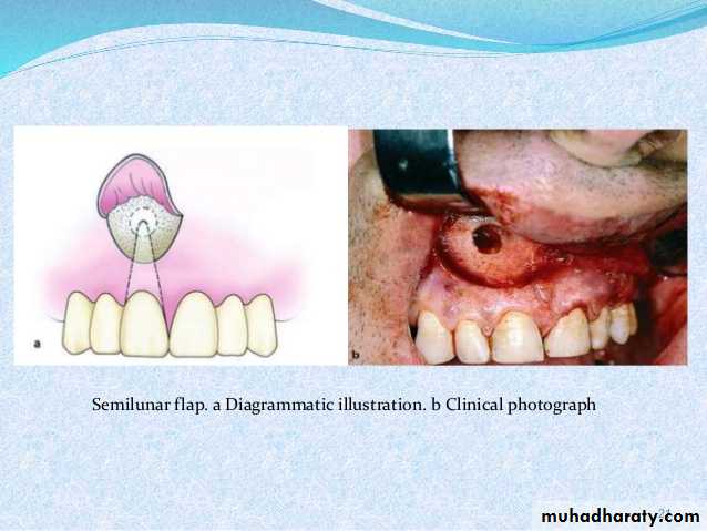 Surgical extraction