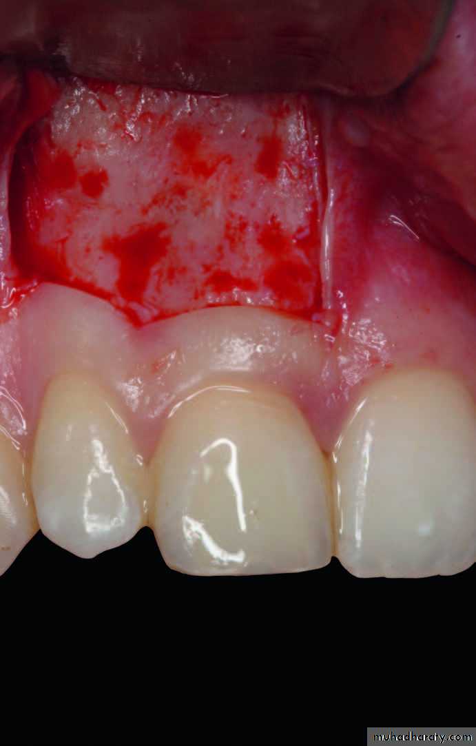 Surgical extraction