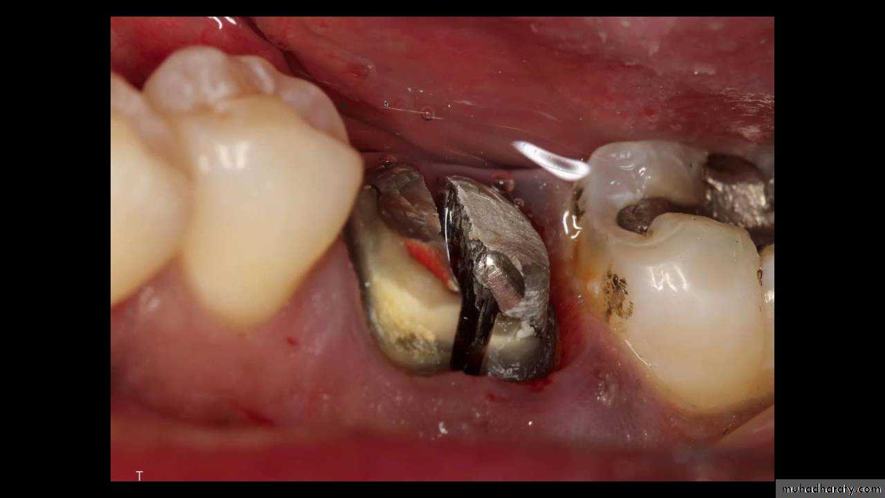 Surgical extraction