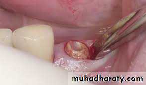 Surgical extraction
