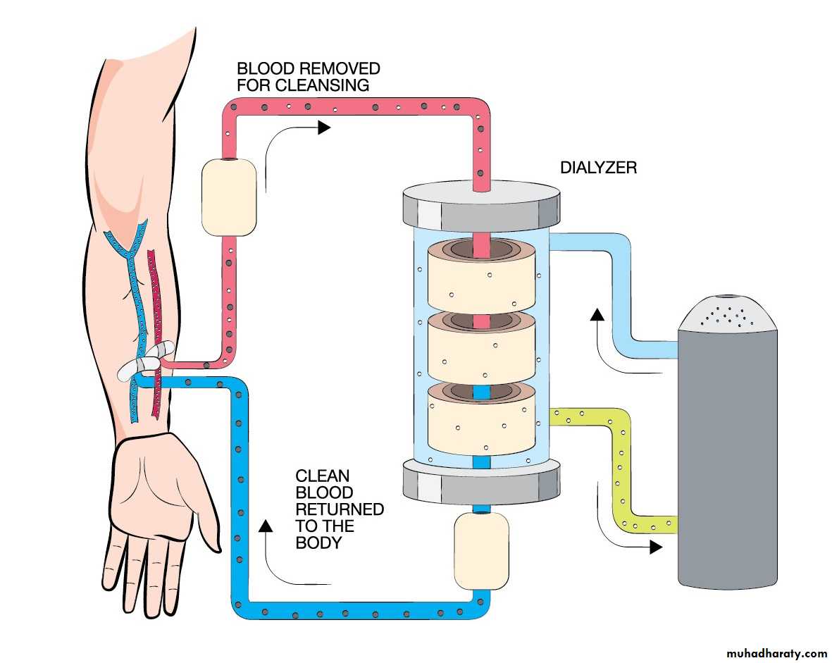 Renal failure