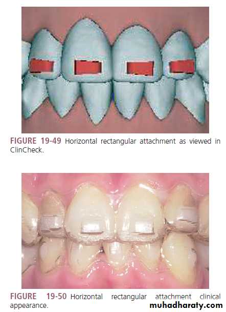 Invisalign in orthodontics