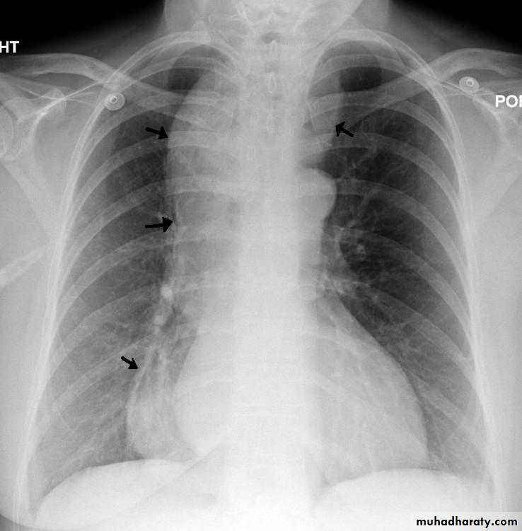 Esophagus