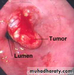 Esophagus
