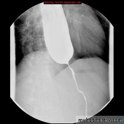 Esophagus