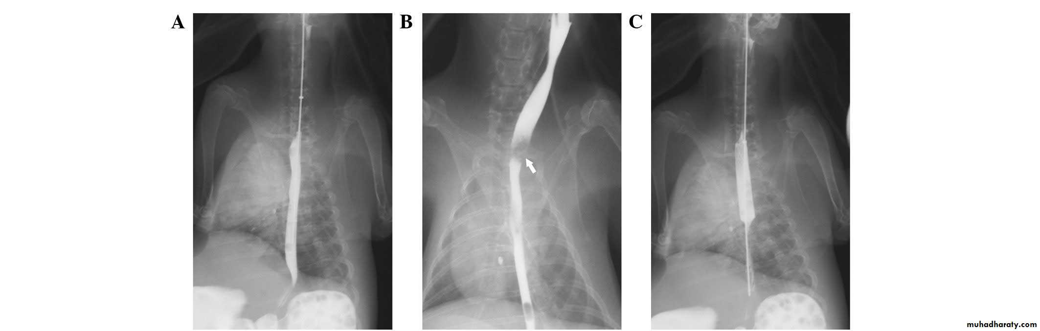 Esophagus