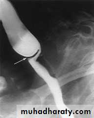 Esophagus