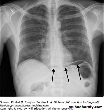 Esophagus