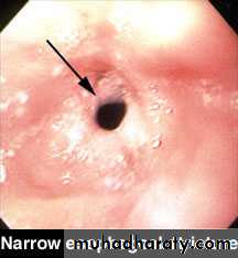 Esophagus