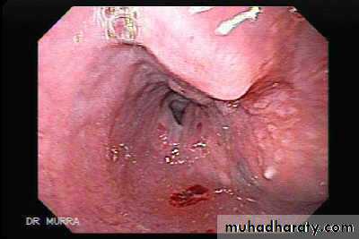 Esophagus
