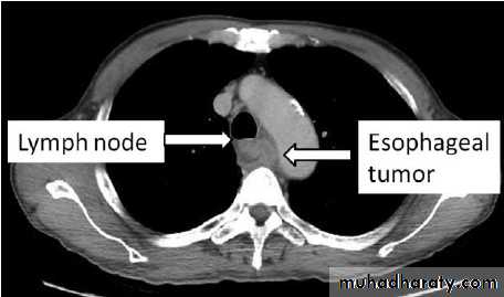 Esophagus