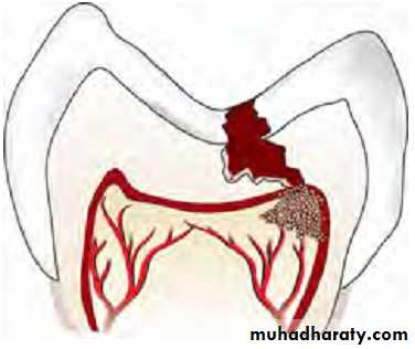 Pulpal diseases and related periapical pathosis part1