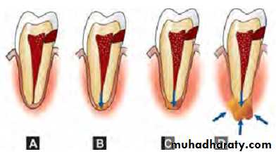 Pulpal diseases and related periapical pathosis part1