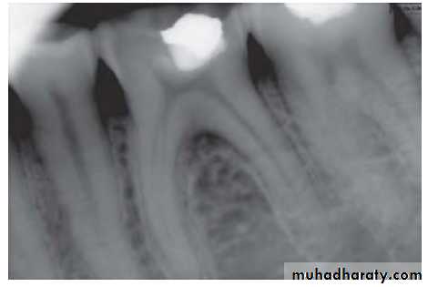 Pulpal diseases and related periapical pathosis part1