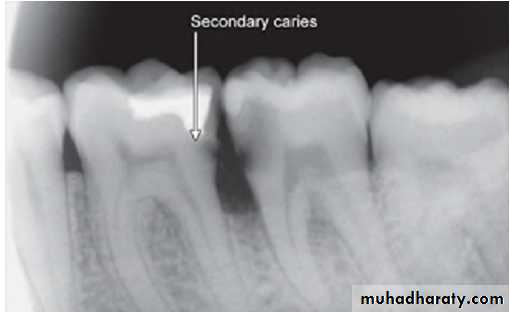 Pulpal diseases and related periapical pathosis part1