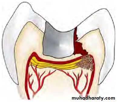 Pulpal diseases and related periapical pathosis part1