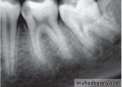 Pulpal diseases and related periapical pathosis part1