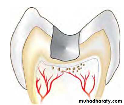 Pulpal diseases and related periapical pathosis part1