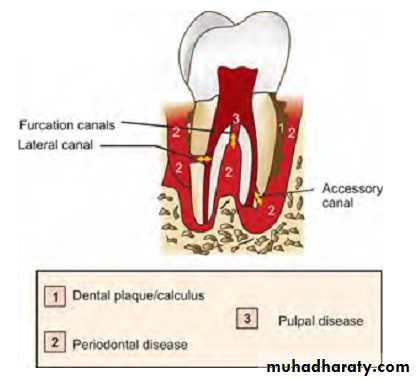 Pulpal diseases and related periapical pathosis part1